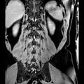Bilateral conjoined nerve roots at different levels (Radiopaedia 73312-84063 B 40).jpg