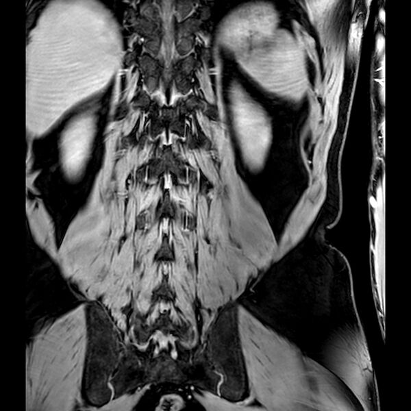 File:Bilateral conjoined nerve roots at different levels (Radiopaedia 73312-84063 B 40).jpg