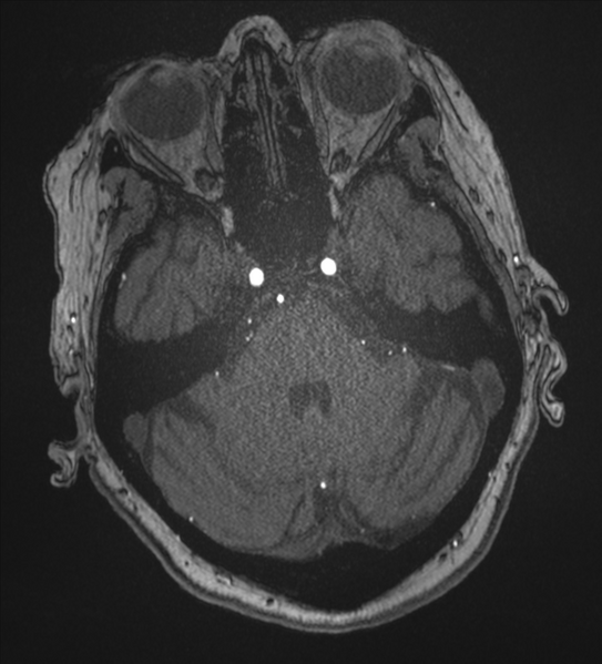 File:Bilateral fetal posterior communicating arteries (Radiopaedia 41286-44102 Axial MRA 50).png