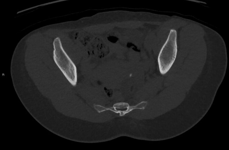 File:Bilateral mature cystic ovarian teratoma (Radiopaedia 88821-105592 Axial bone window 16).jpg