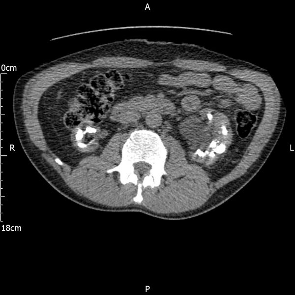 File:Bilateral medullary nephrocalcinosis with ureteric calculi (Radiopaedia 71269-81569 Axial non-contrast 50).jpg