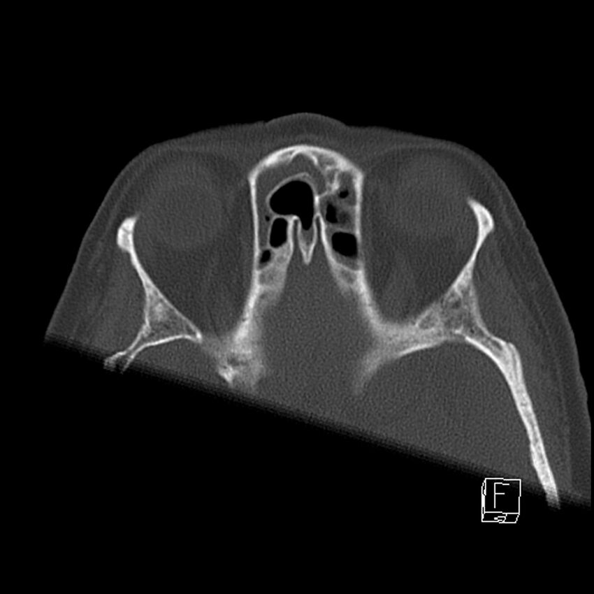 Bilateral palatine tonsilloliths on OPG and CT (Radiopaedia 75167-86247 Axial bone window 3).jpg