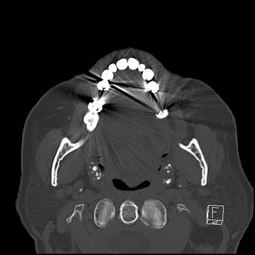 Bilateral palatine tonsilloliths on OPG and CT (Radiopaedia 75167-86247 Axial bone window 39).jpg
