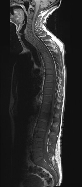 File:Bing-Neel syndrome (Radiopaedia 71453-81799 Sagittal T1 7).jpg