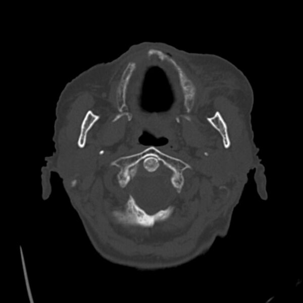 File:Biparietal osteodystrophy (Radiopaedia 46109-50463 bone window 6).jpg