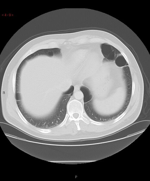 File:Birt-Hogg-Dubé syndrome (Radiopaedia 53814-60013 Axial lung window 9).jpg