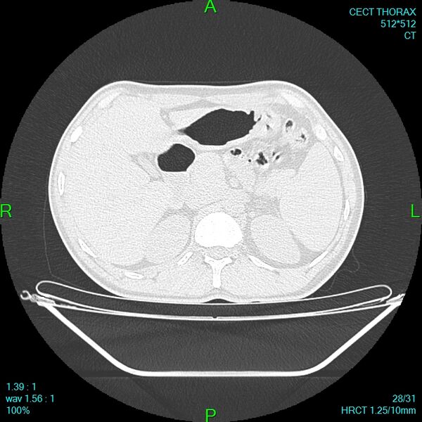 File:Bone metastases from lung carcinoma (Radiopaedia 54703-60937 Axial lung window 28).jpg