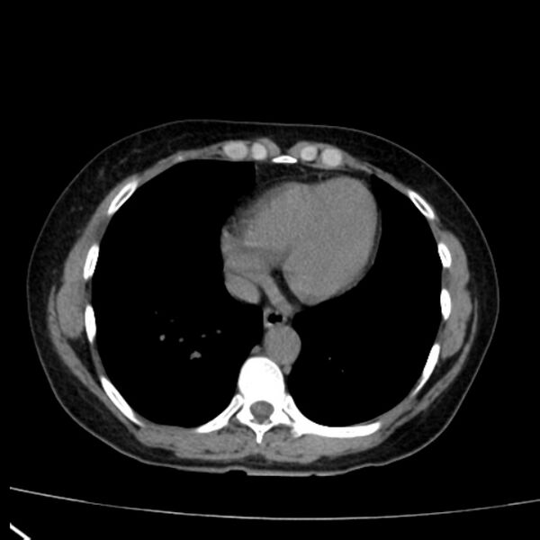 File:Bosniak renal cyst - type I (Radiopaedia 27479-27675 Axial non-contrast 3).jpg