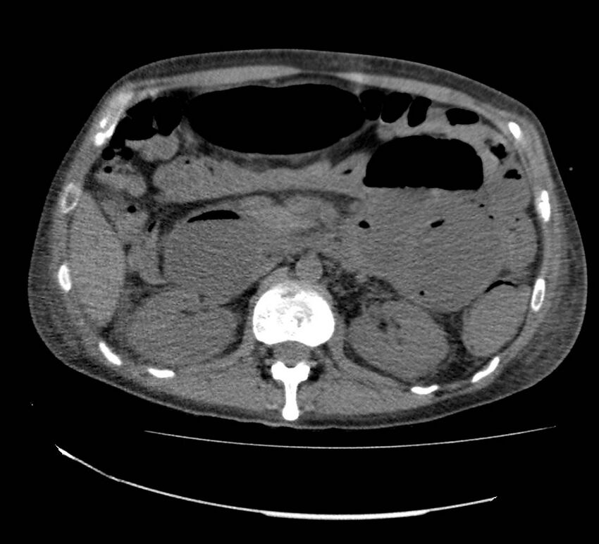 Bowel lymphoma complicated by bleeding after therapy (Radiopaedia 55601-62110 Axial non-contrast 32).jpg