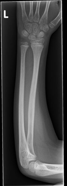 File:Bowing fracture radius and ulna (Radiopaedia 44173-47759 Frontal 1).jpg