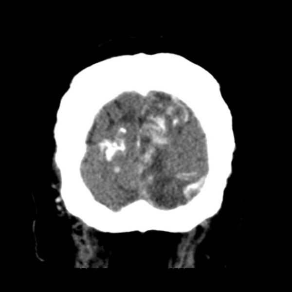 File:Brain cortical laminar necrosis (Radiopaedia 25822-25971 C 50).jpg