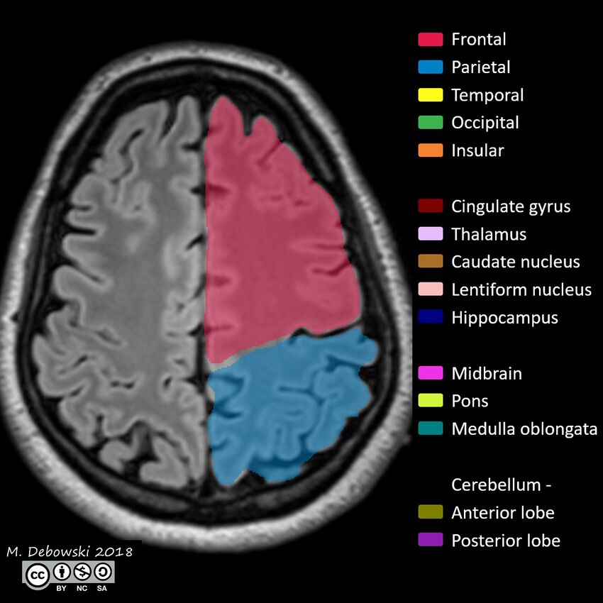 Brain lobes - annotated MRI (Radiopaedia 61691-69700 Axial 17).JPG