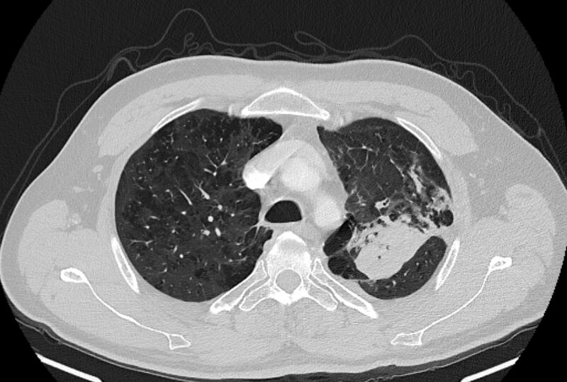 File:Brain metastases - lung cancer primary (Radiopaedia 75060-86116 Axial lung window 12).jpg