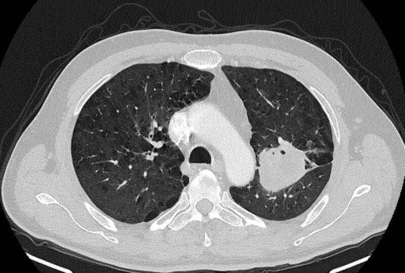 File:Brain metastases - lung cancer primary (Radiopaedia 75060-86116 Axial lung window 17).jpg