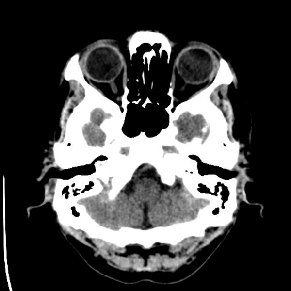 File:Brain metastases from lung cancer (Radiopaedia 24480-24781 Axial non-contrast 5).jpg