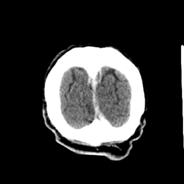 File:Brain metastases from lung cancer (Radiopaedia 27849-28092 Coronal C+ delayed 65).jpg