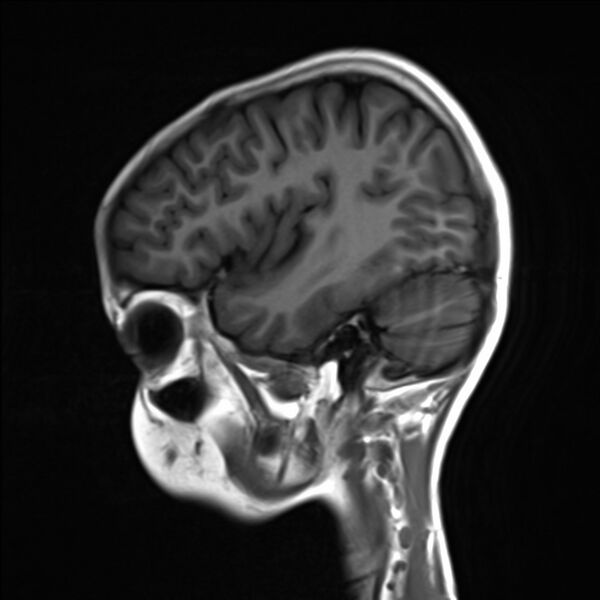 File:Brainstem glioma (Radiopaedia 70548-80674 Sagittal T1 4).jpg