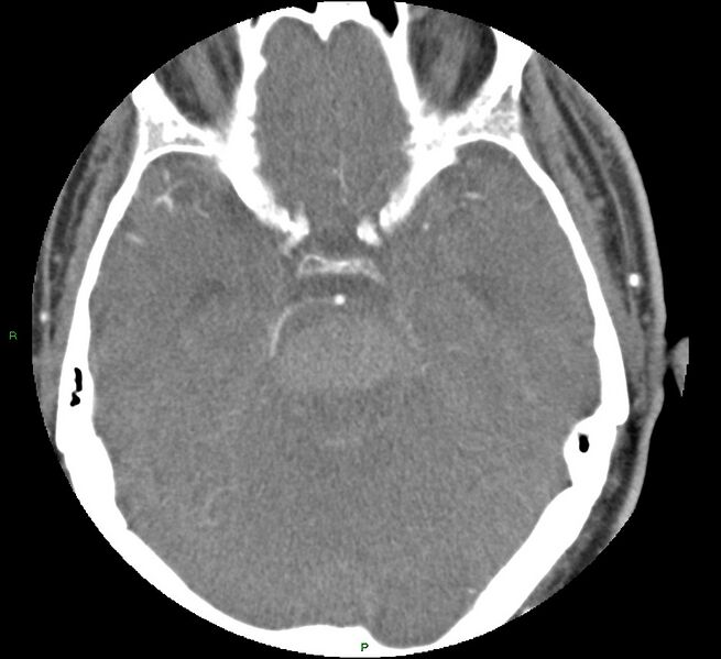 File:Brainstem hemorrhage (Radiopaedia 58794-66028 D 69).jpg