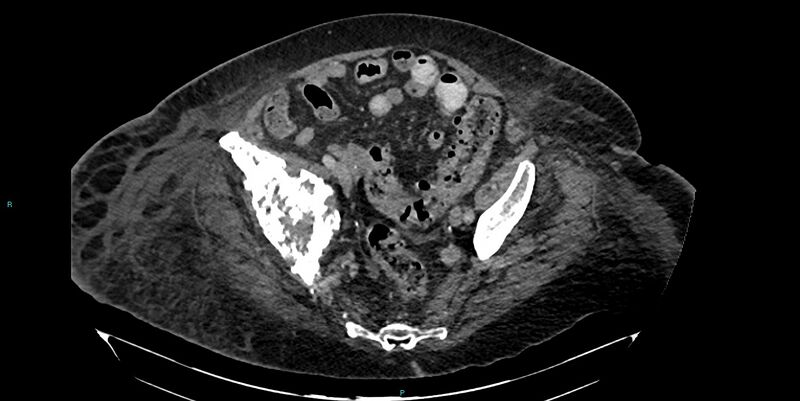 File:Breast cancer pelvic bony metastases (Radiopaedia 84470-99824 Axial bone window 42).jpg