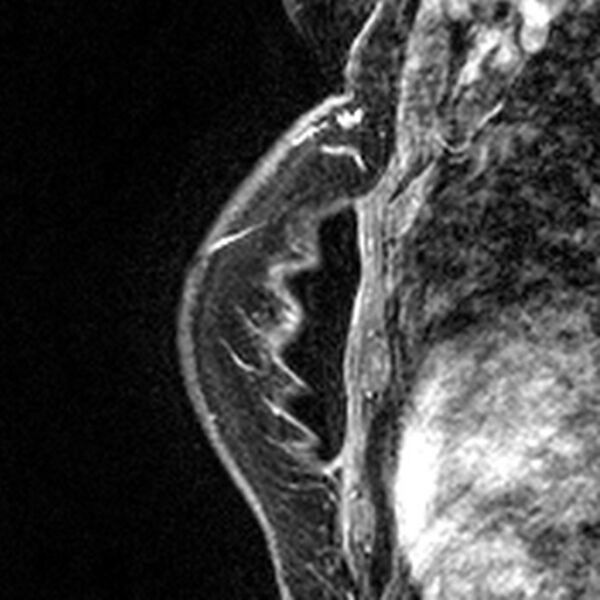 File:Breast implants - MRI (Radiopaedia 26864-27035 Sagittal T2 45).jpg