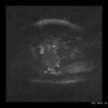 Broad ligament fibroid (Radiopaedia 49135-54241 Axial DWI 20).jpg