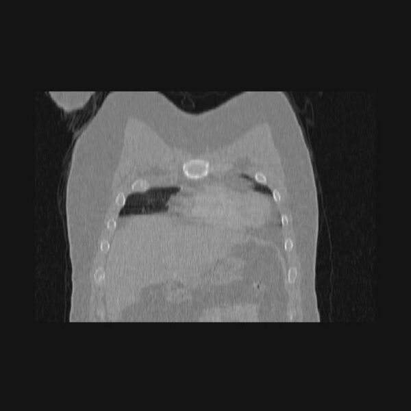 File:Bronchial atresia (Radiopaedia 60685-68439 Coronal lung window 66).jpg