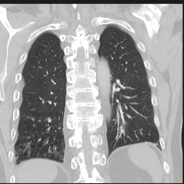 File:Bronchiectasis (Radiopaedia 39385-41666 Coronal lung window 26).png
