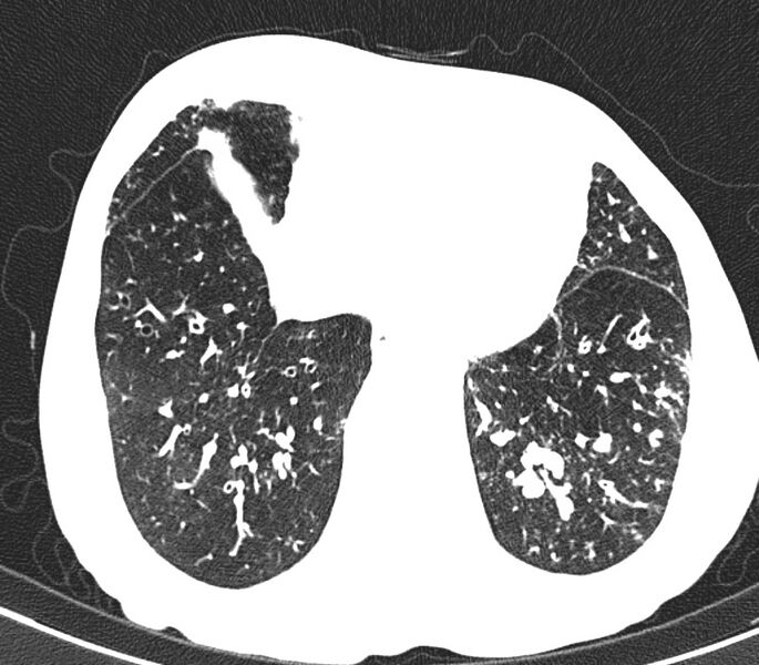 File:Bronchiolitis (Radiopaedia 24616-24887 Axial lung window 47).jpg