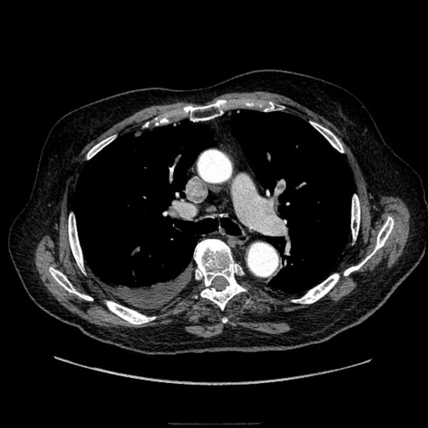 File:Bronchogenic adenocarcinoma and pulmonary embolism (Radiopaedia 9097-9806 D 28).jpg