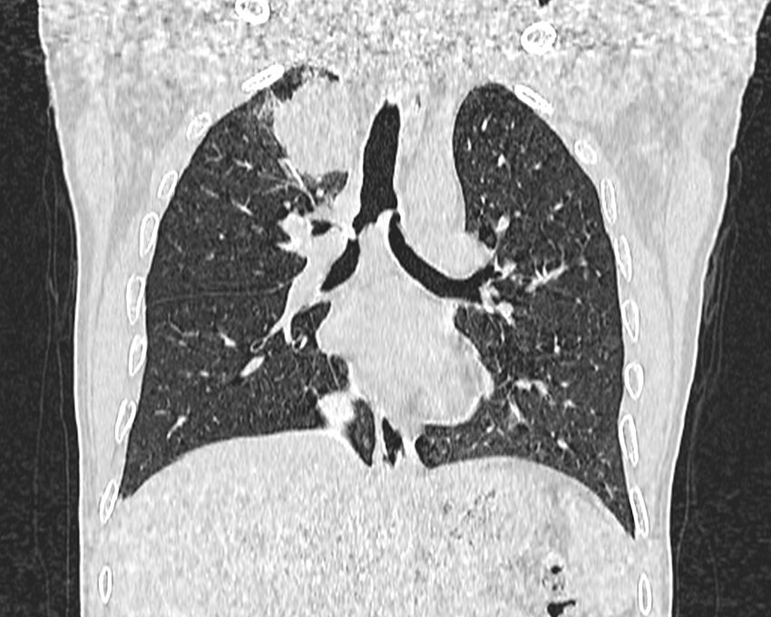 Bronchogenic carcinoma with superior vena cava syndrome (Radiopaedia 36497-38054 Coronal lung window 43).jpg