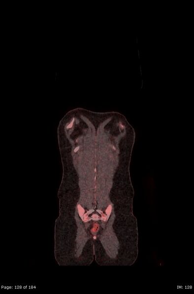 File:Brown fat uptake (FDG PET-CT) (Radiopaedia 77392-89513 Fused coronal 86).jpg