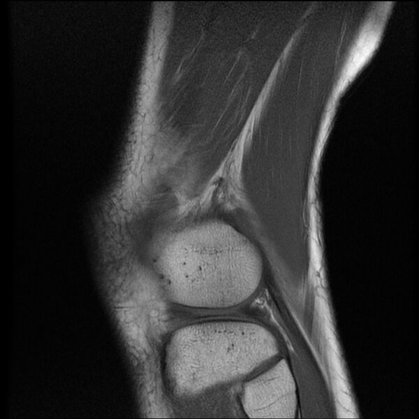File:Bucket-handle meniscus tear (Radiopaedia 65700-74809 Sagittal T1 19).jpg