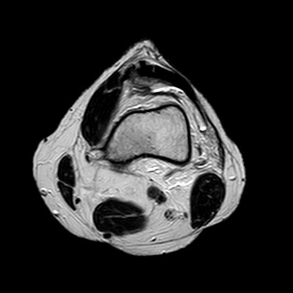 File:Bucket handle tear - medial meniscus (Radiopaedia 29250-29664 Axial T2 16).jpg