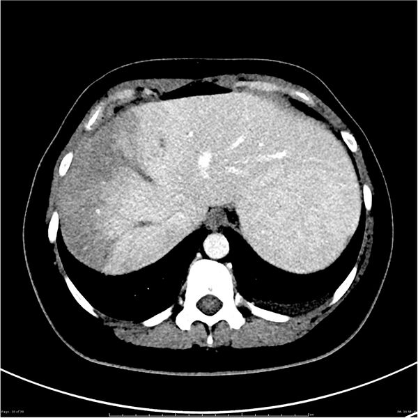 File:Budd-Chiari syndrome (Radiopaedia 27929-28177 Axial liver window 10).JPG