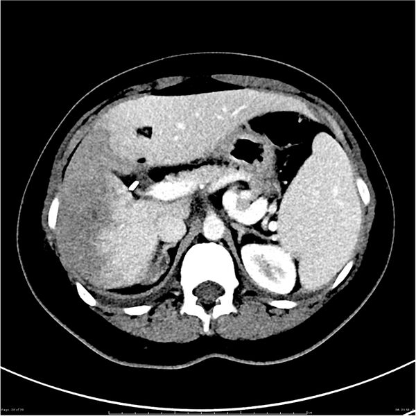 File:Budd-Chiari syndrome (Radiopaedia 27929-28177 Axial liver window 20).JPG
