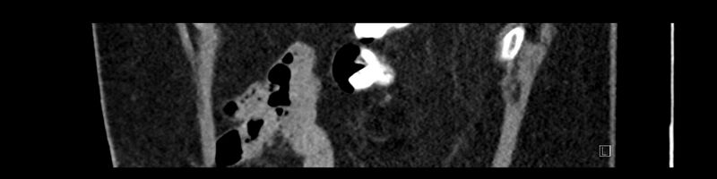 File:Buried bumper syndrome - gastrostomy tube (Radiopaedia 63843-72575 Sagittal Inject 18).jpg