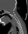 Butterfly vertebra (Radiopaedia 77903-90209 Sagittal bone window 29).jpg
