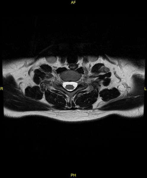 File:C5 nerve sheath tumor (Radiopaedia 85777-101596 Axial T2 64).jpg