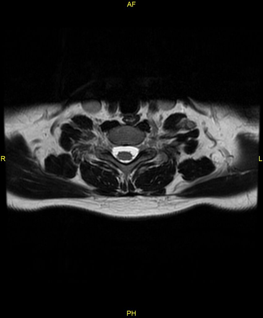 C5 nerve sheath tumor (Radiopaedia 85777-101596 Axial T2 64).jpg