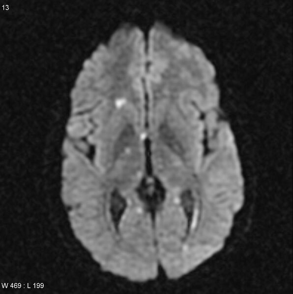 File:CMV ventriculitis and encephalitis (Radiopaedia 5416-7166 Axial DWI 2).jpg