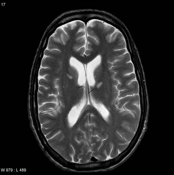 File:CMV ventriculitis and encephalitis (Radiopaedia 5416-7166 T2 4).jpg