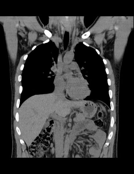 File:Calcifying pulmonary metastases (Radiopaedia 33359-34396 Coronal non-contrast 28).jpg