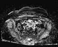 Cancer cervix - stage IIb (Radiopaedia 75411-86615 Axial ADC 24).jpg