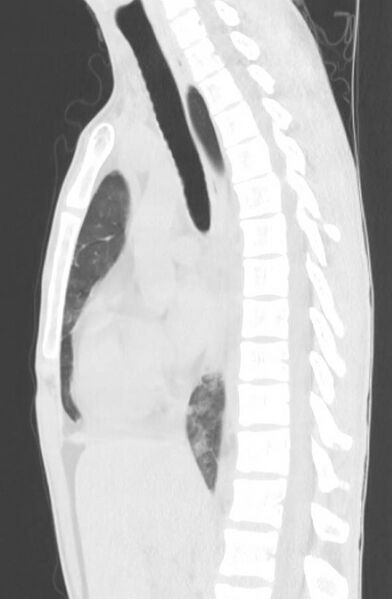 File:Cannabis-induced diffuse alveolar hemorrhage (Radiopaedia 89834-106946 Sagittal lung window 69).jpg