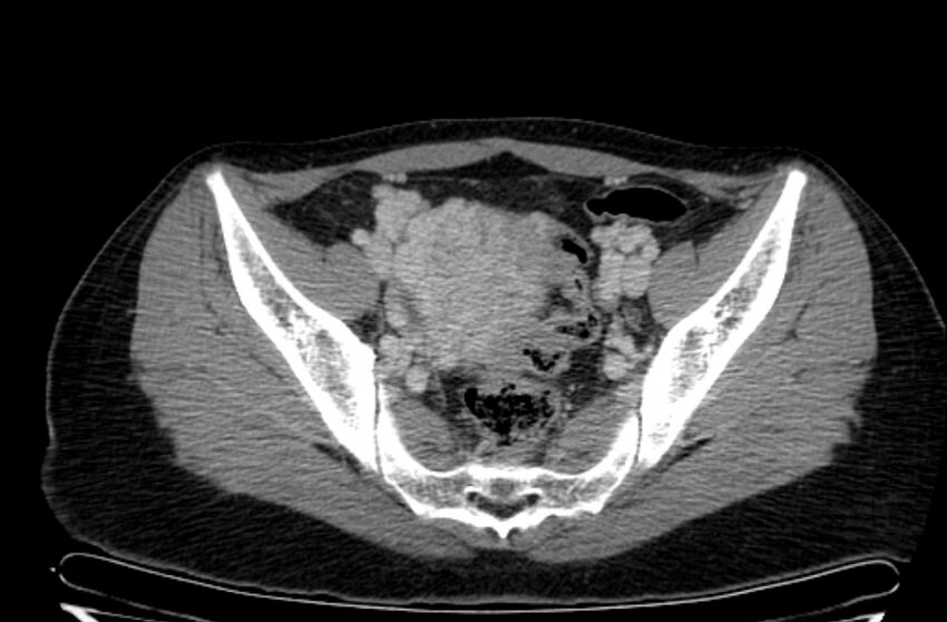 Cannonball metastases - uterine choriocarcinoma (Radiopaedia 70137-80174 A 17).jpg