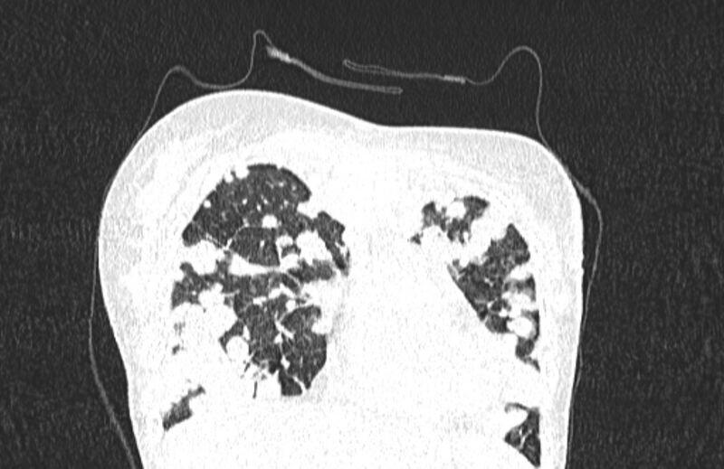 File:Cannonball metastases from breast cancer (Radiopaedia 91024-108569 Coronal lung window 25).jpg