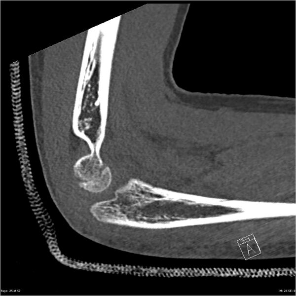 File:Capitellum fracture (Radiopaedia 23352-23426 Sagittal bone window 25).jpg