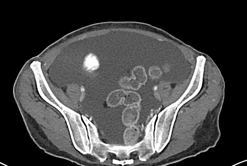 File:Carcinoid mesenteric tumor complicated by chylous ascites (Radiopaedia 76312-87953 A 60).jpg