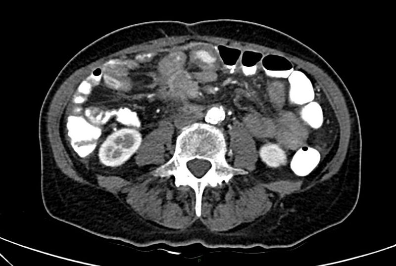 File:Carcinoid mesenteric tumor complicated by chylous ascites (Radiopaedia 76312-88926 A 40).jpg