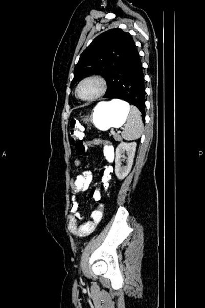File:Carcinoma of uterine cervix (Radiopaedia 85861-101700 D 65).jpg